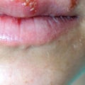 Understanding HSV-1 Infection
