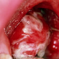 Transmission of Epstein-Barr Virus (EBV)