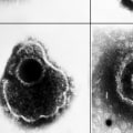 Comparing Symptoms of HSV-1 and HSV-2