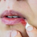 Docosanol Cream: Treatment for Herpes
