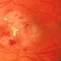 Transmission of Cytomegalovirus (CMV)