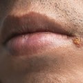 Understand the Risk Factors for HSV-1 and HSV-2