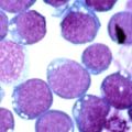 Understanding the Treatment of Epstein-Barr Virus