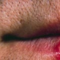 Understanding the Role of a Weakened Immune System in Labialis Herpes