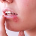 Genital Contact and Herpes: Everything You Need to Know