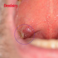 Exploring the Relationship Between Oral Sex and Herpes