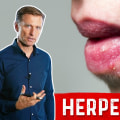 Eating a Balanced Diet for Herpes Symptoms Management