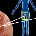 Understanding HSV-2 Infection