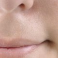 Understanding Stress and Herpes