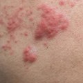 Understanding Genital Herpes caused by Varicella Zoster Virus (HSV-3)