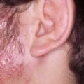 Everything You Need to Know About Herpes Gladiatorum (HSV-5)