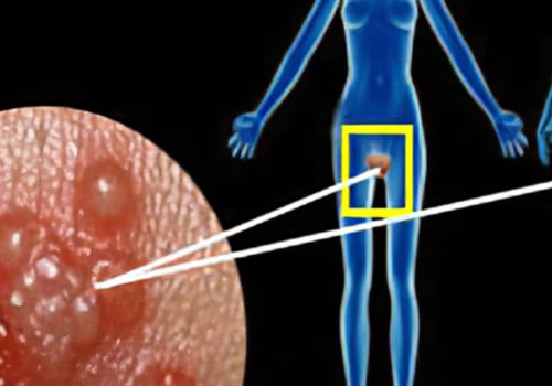 Exploring Sexual Contact - Causes of Labialis Herpes & Environmental Factors
