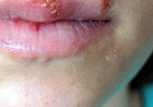 Skin Damage and Herpes: An In-Depth Look at Causes and Environmental Factors