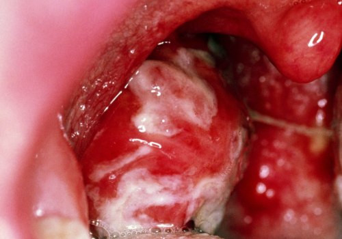 Transmission of Epstein-Barr Virus (EBV)
