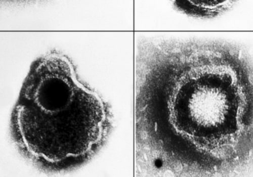 Comparing Symptoms of HSV-1 and HSV-2