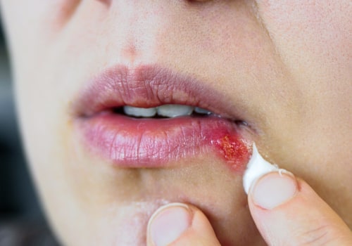 Docosanol Cream: Treatment for Herpes