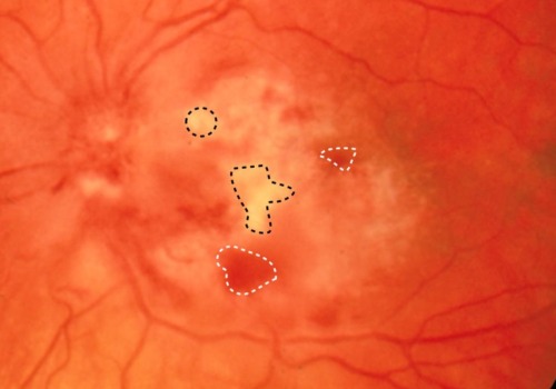 Transmission of Cytomegalovirus (CMV)
