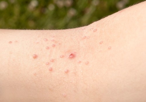 Understanding Molluscum Contagiosum (HSV-6)