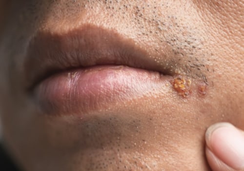 Understand the Risk Factors for HSV-1 and HSV-2