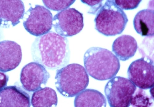 Understanding the Treatment of Epstein-Barr Virus