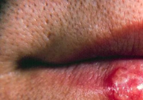 Understanding the Role of a Weakened Immune System in Labialis Herpes