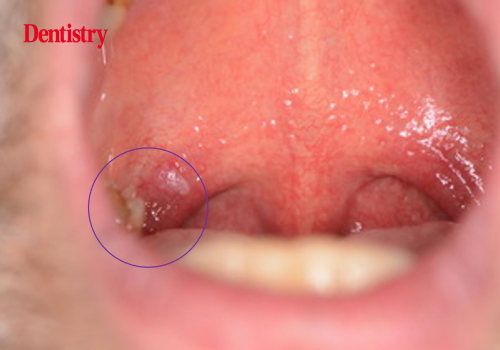 Exploring the Relationship Between Oral Sex and Herpes