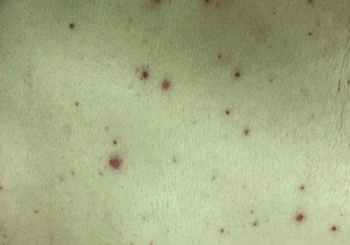 What Are the Symptoms of Varicella Zoster Virus (VZV)?