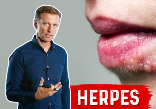 Eating a Balanced Diet for Herpes Symptoms Management