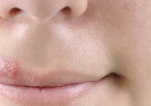 Understanding Stress and Herpes
