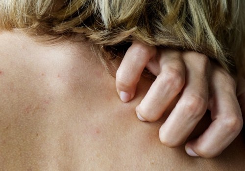 Understanding and Treating Itchiness with Anti-Itch Medications