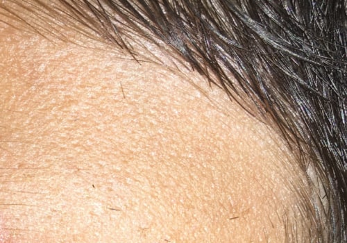 Famciclovir: An Overview of a Common Herpes Treatment and Solution