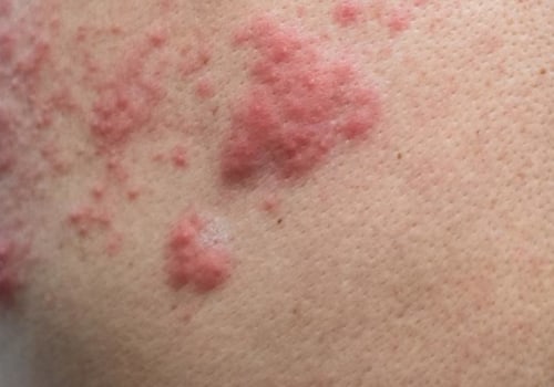 Understanding Genital Herpes caused by Varicella Zoster Virus (HSV-3)