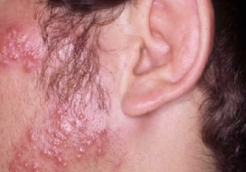 Everything You Need to Know About Herpes Gladiatorum (HSV-5)